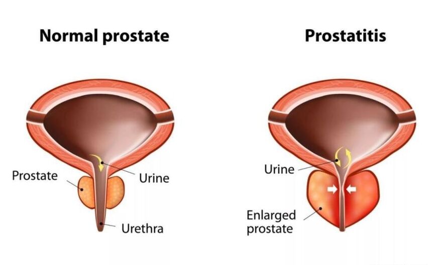 Próstata normal e inflamado