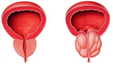 Próstata saudable e inflamada con prostatite