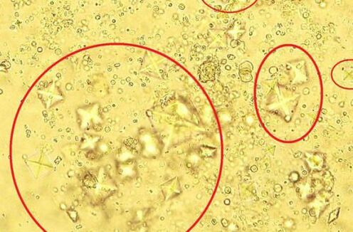 Así se ven baixo o microscopio os cristais de sal contidos na urina con prostatite calculosa