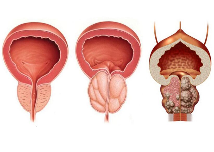 etapas da prostatite e a necesidade de tratamento con Prostavit